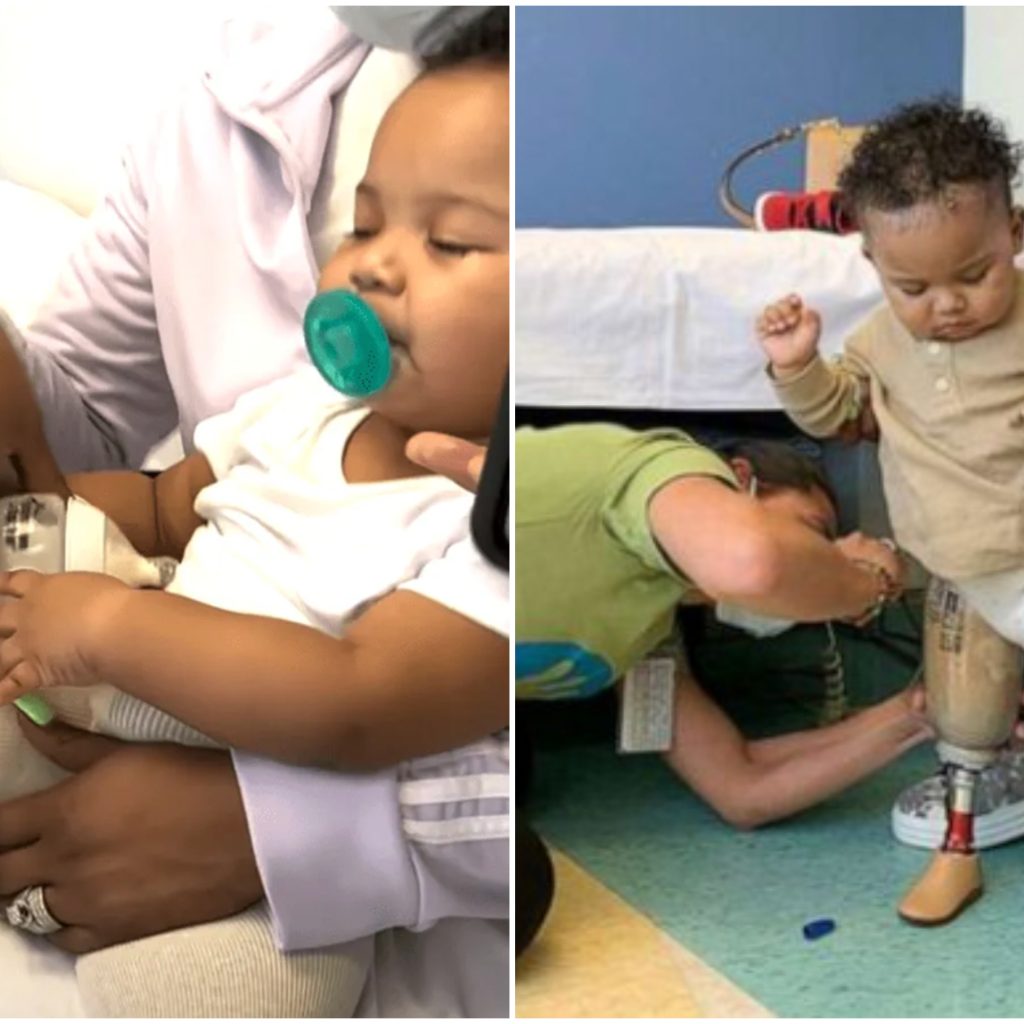 Az 1 éves babának amputálták a lábát, de nem adta fel és 8 hónap után megteszi az első lépéseit